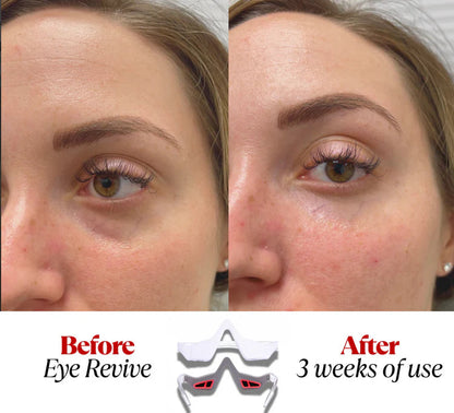 Under-Eye Red Light Therapy Wellia