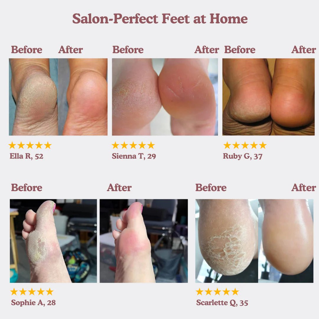 Foot Callus Remover My Store