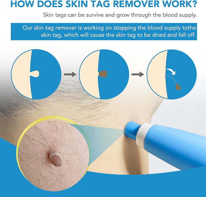 Skin Tag Remover My Store